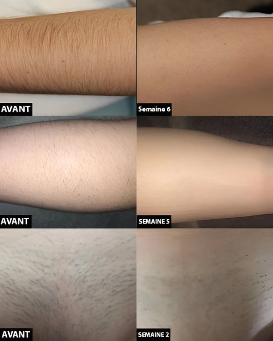 Permanent Laser Hair Removal Device for Face and Body - SJ Backyard